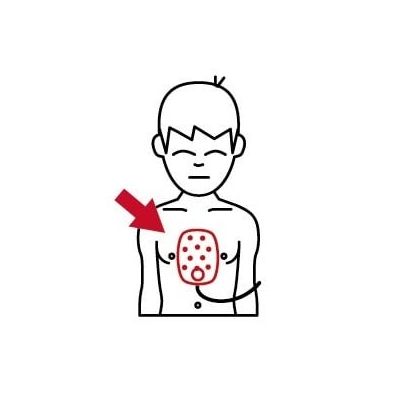 HeartStart Infant/Child Pad Placement Guide
